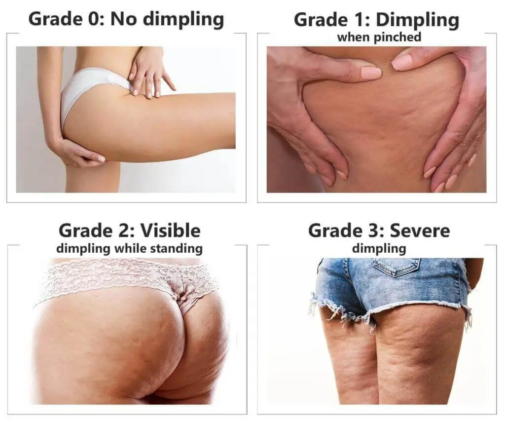 Representation of the stages of cellulite development Byfleet